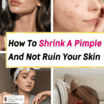 How To Get Rid Of Pimples Overnight