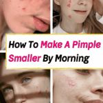 How to shrink a pimple overnight without toothpaste